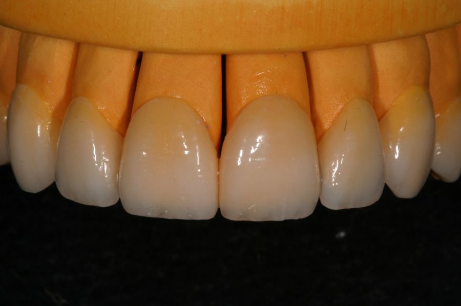 Finished veneers on a working model