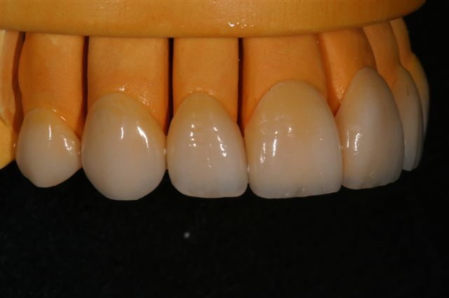 Veneers on a model, front view