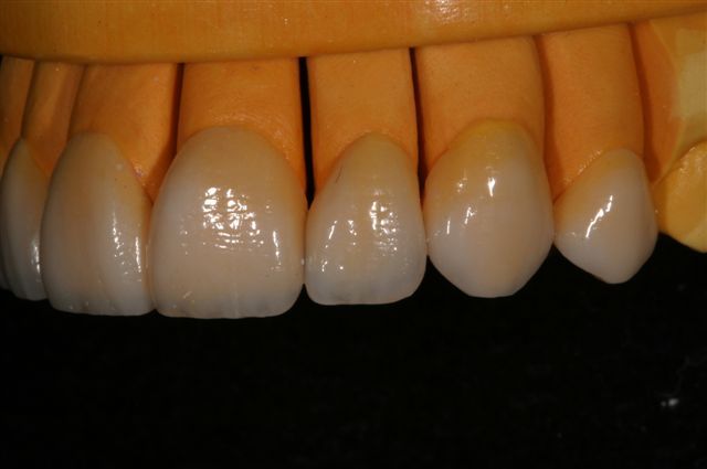 Veneers on a model, side view