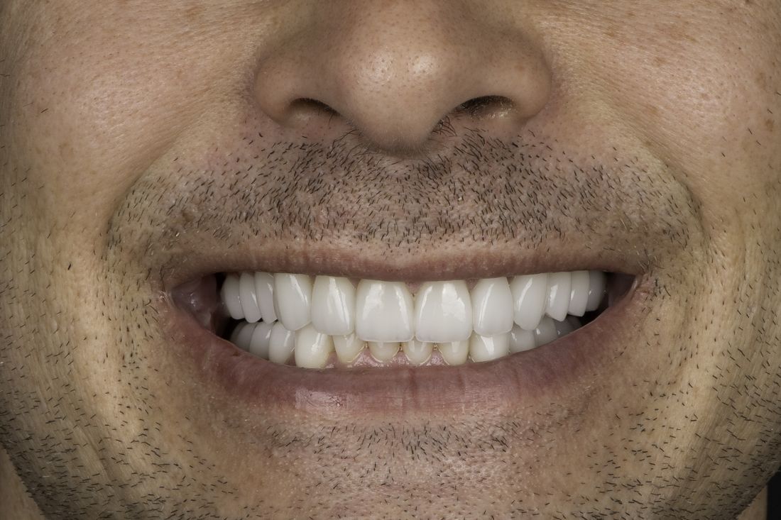 The same patient's smile after treatment