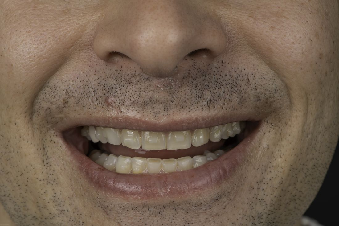 Patient smile before treatment