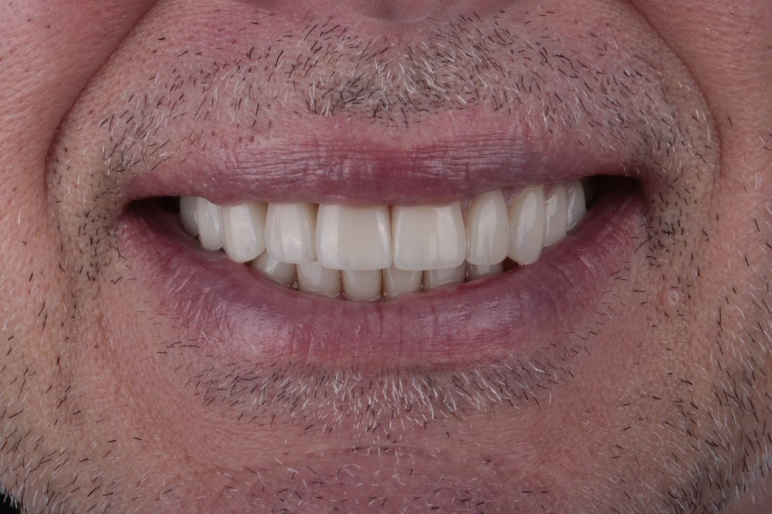 The same patient's smile after treatment