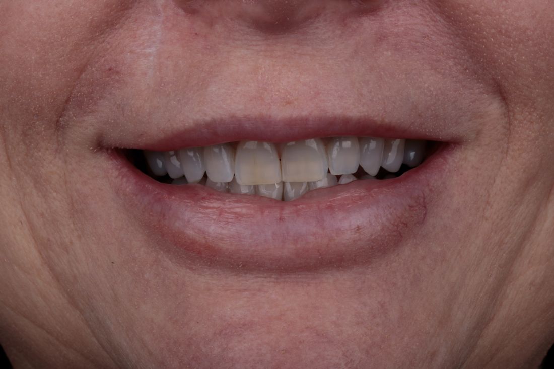 Patient smile before treatment