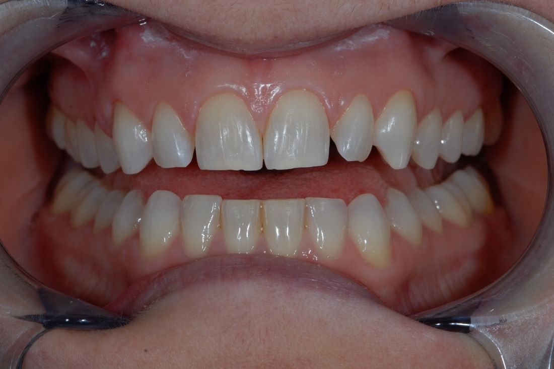 Patient smile before treatment