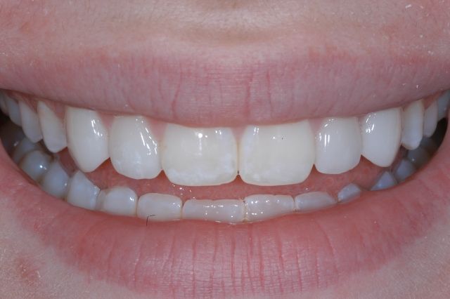 The same patient's smile after treatment
