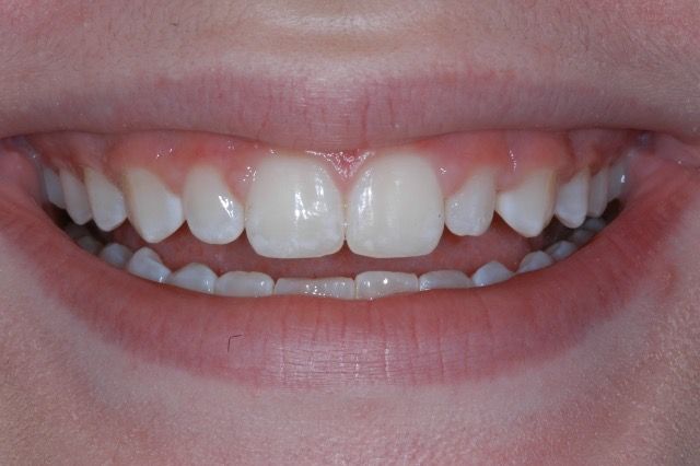 Patient smile before treatment