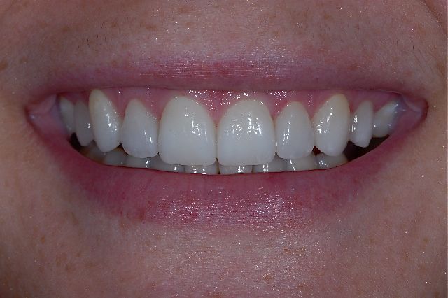 The same patient's smile after treatment