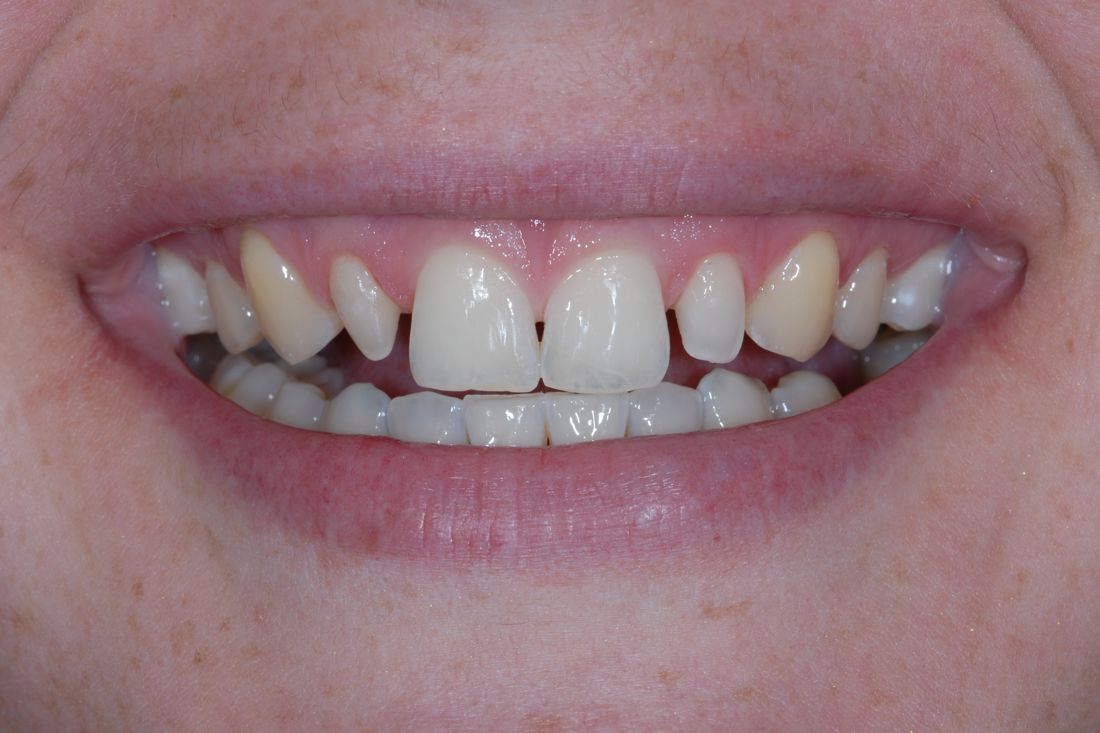 Patient smile before treatment