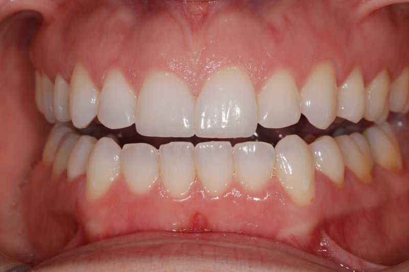 The same patient's smile after treatment